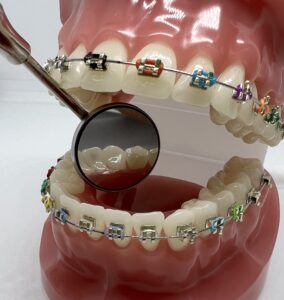 Ortodoncja - Aparat