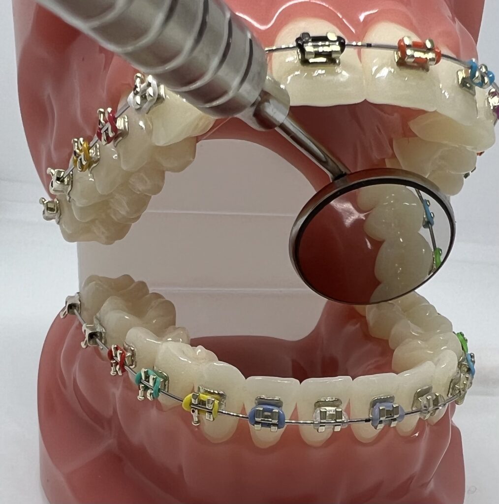 Ortodoncja - aparat na zęby