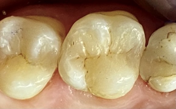 Stomatologia zachowawcza - ząb po leczeniu