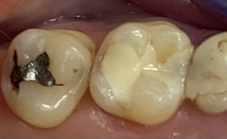 Stomatologia zachowawcza - ząb przed leczeniem