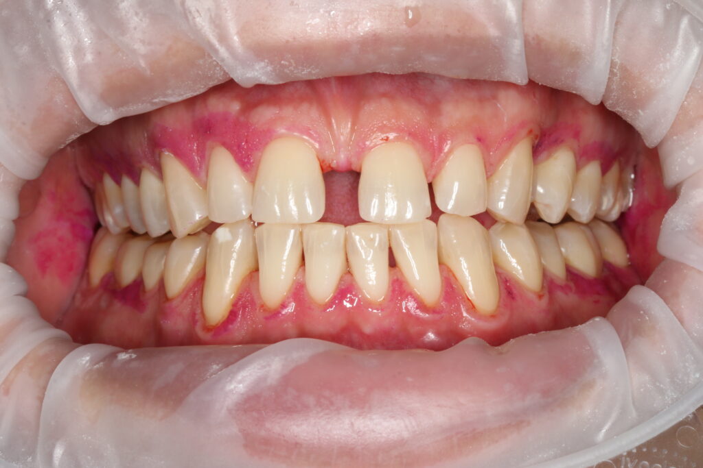 Szpary między zębami – co zrobić