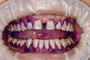 Profesjonalna higienizacja- Zdjęcie zęby wybarwione