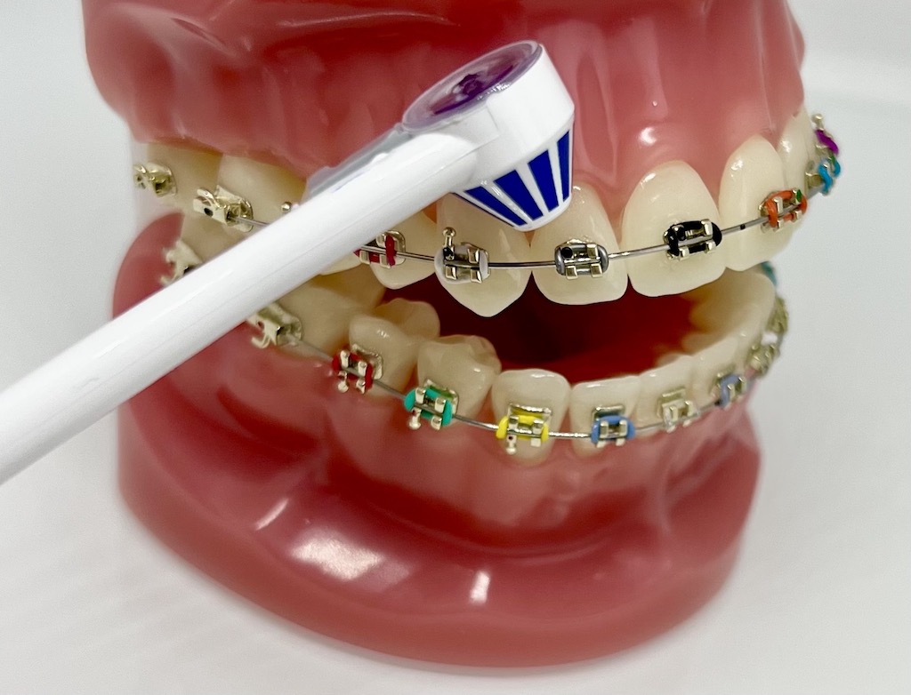Higiena w aparacie ortodontycznym - irygator