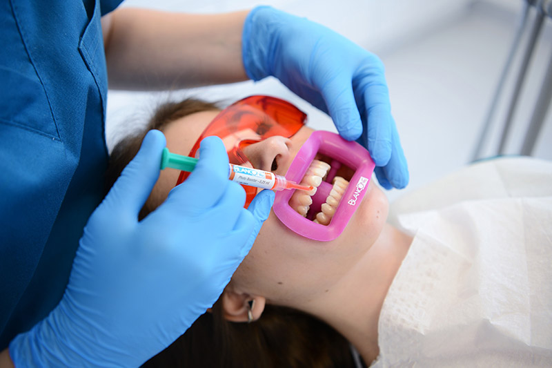 Wybielanie zębów nanoszenie preparatu