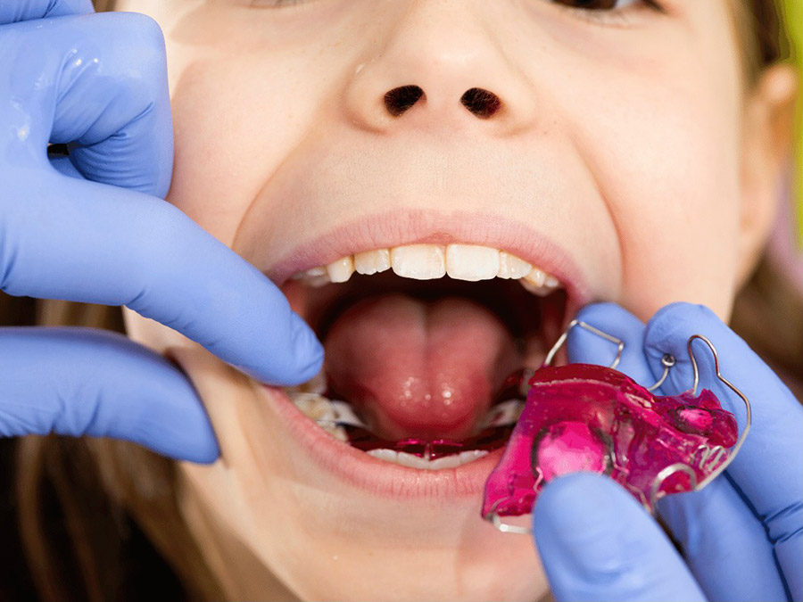 Ortodoncja dziecięca - instalacja aparatu