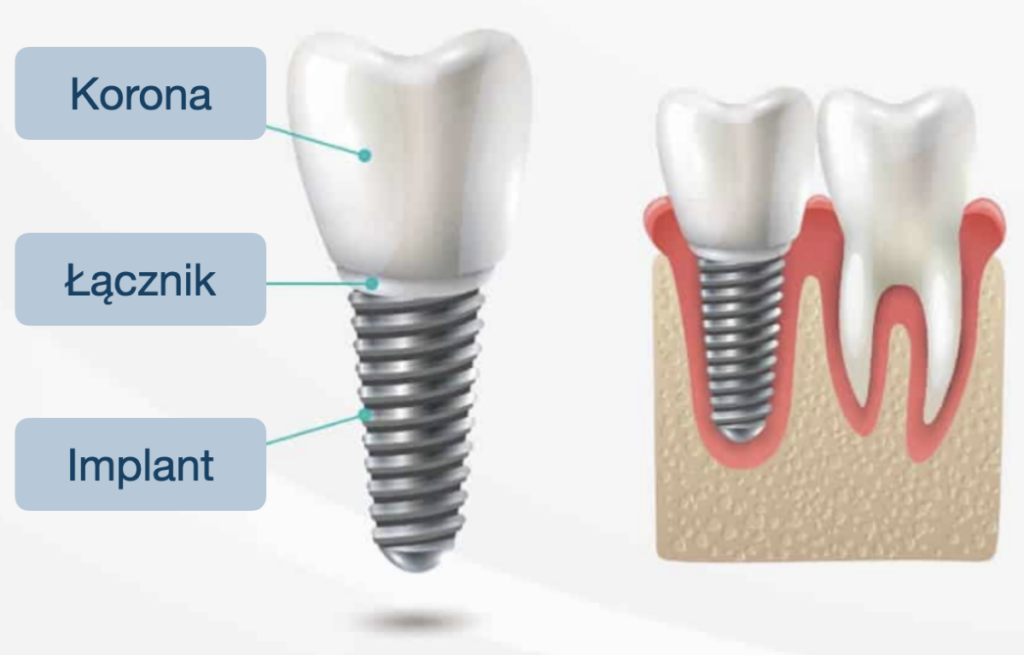 Implanty zębowe - schemat implantu