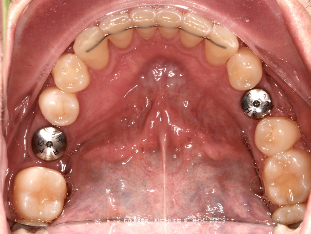 Implanty zębowe - śruby gojące