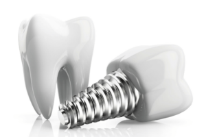 Jakie są rodzaje implantów dentystycznych
