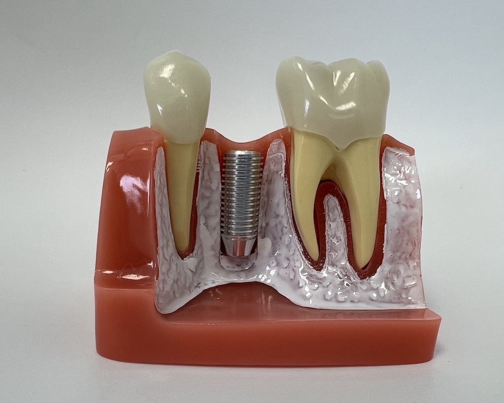 Zalety implantów zębowych w porównaniu z mostami