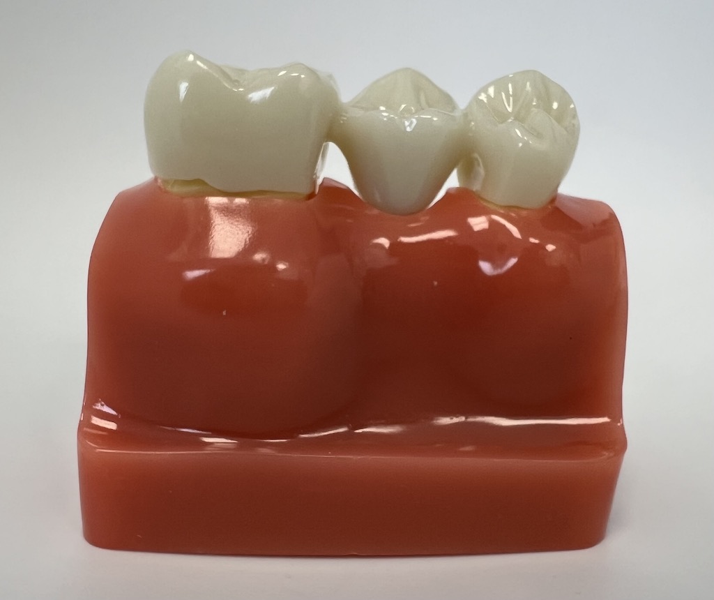 Zalety implantów zębowych w porównaniu z mostami - most