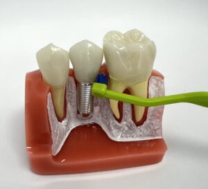 Jak dbać o implanty dentystyczne po zabiegu