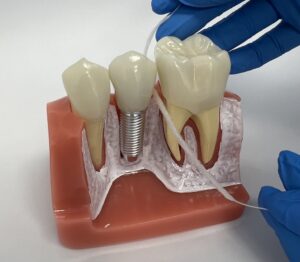 Jak dbać o implanty dentystyczne po zabiegu - nitka